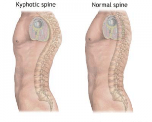 Kyphotic Spine