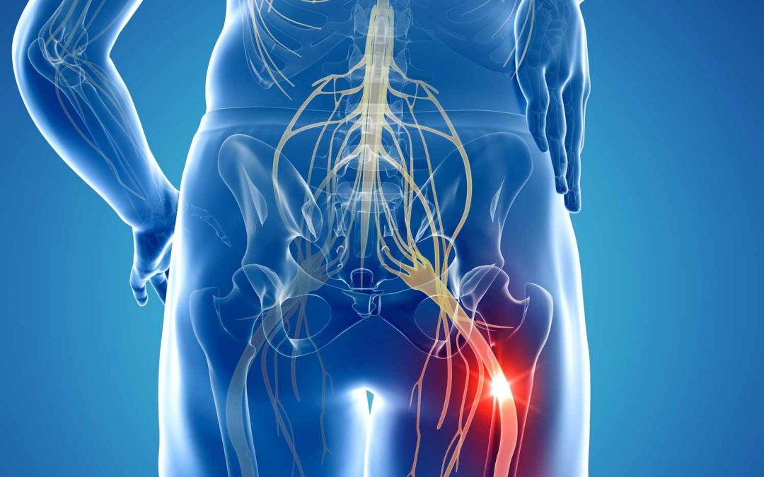 How Acupuncture works for Sciatica Pain