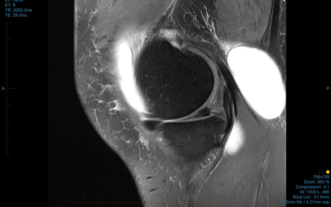 Understanding Baker's Cysts in the knee